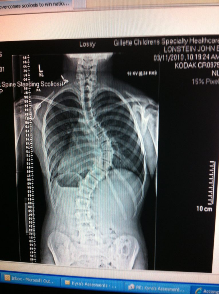 Снимок позвоночника Кайры в 12 лет (до операции)